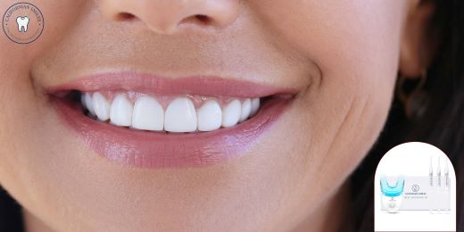 ¿Pueden los kits de blanqueamiento dental ayudar a eliminar las manchas de fluorosis?